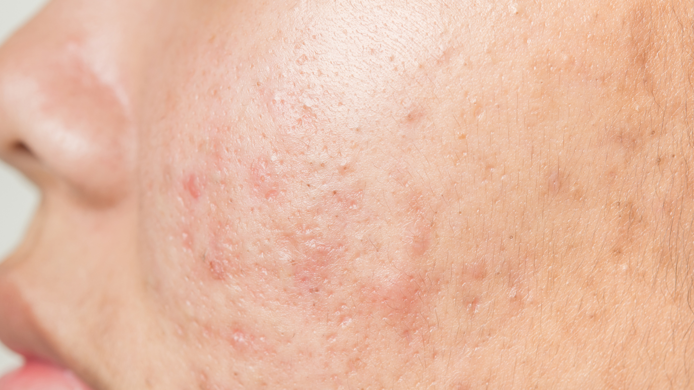 Prix du traitement roaccutane