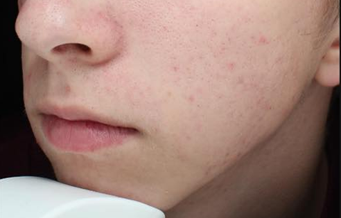 Prix du traitement roaccutane