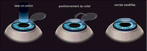 Prix Lasix