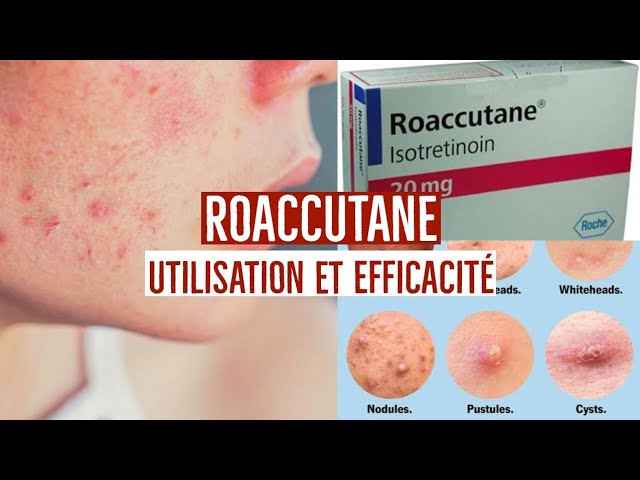 Prix pour accutane
