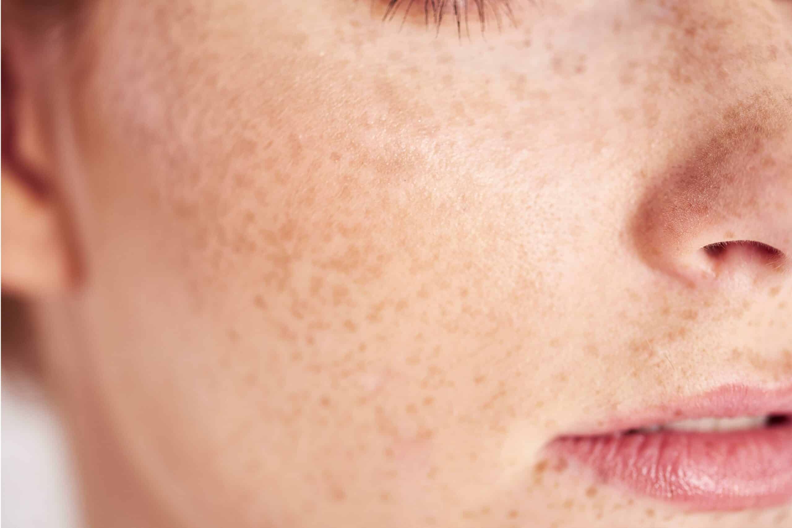 Prix roaccutane crème