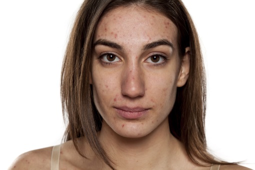 prix roaccutane gel