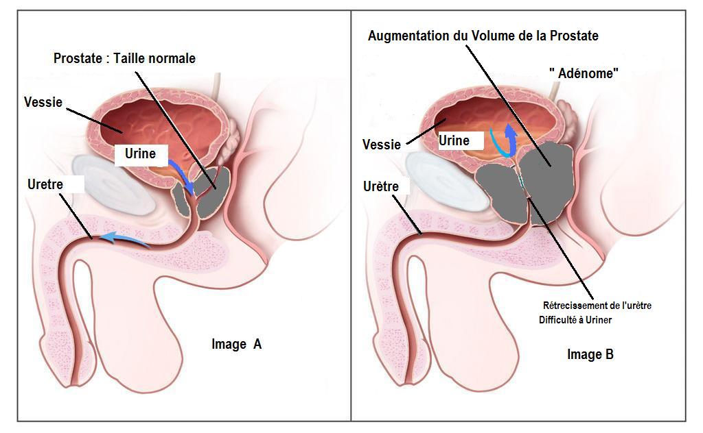Proscar acheter sans ordonnance