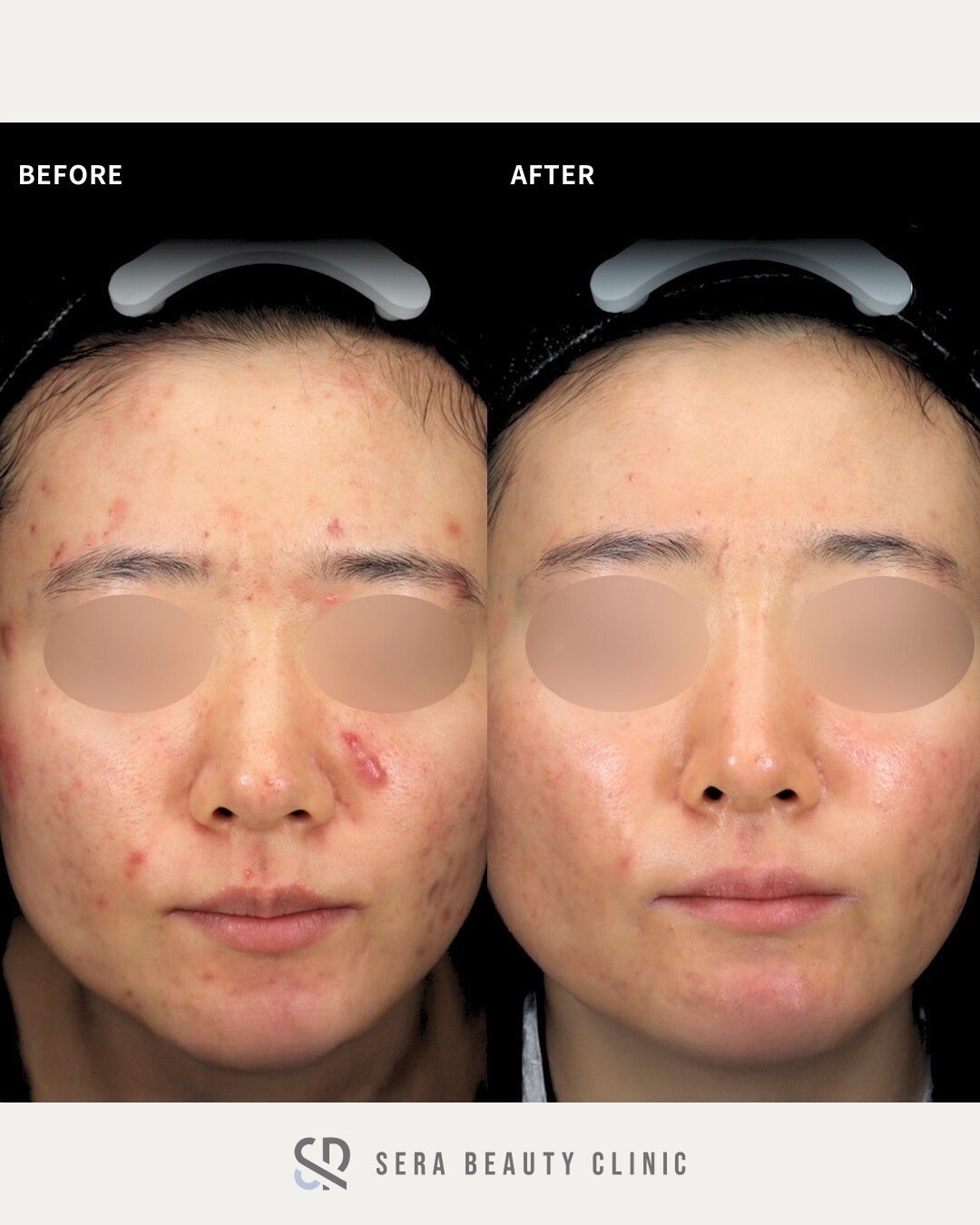 Roaccutane 30mg Online