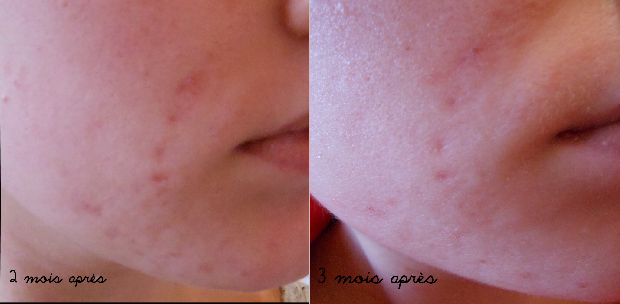 Roaccutane 40mg