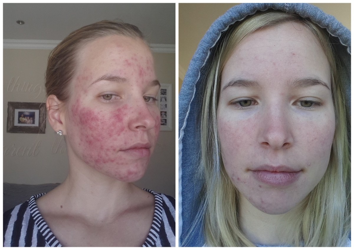Roaccutane Acheter Ligne