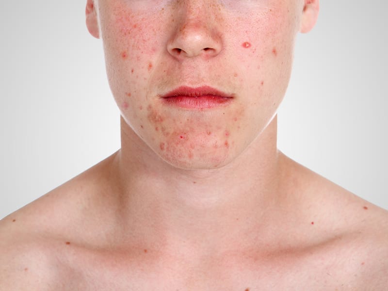 Roaccutane acné pilule