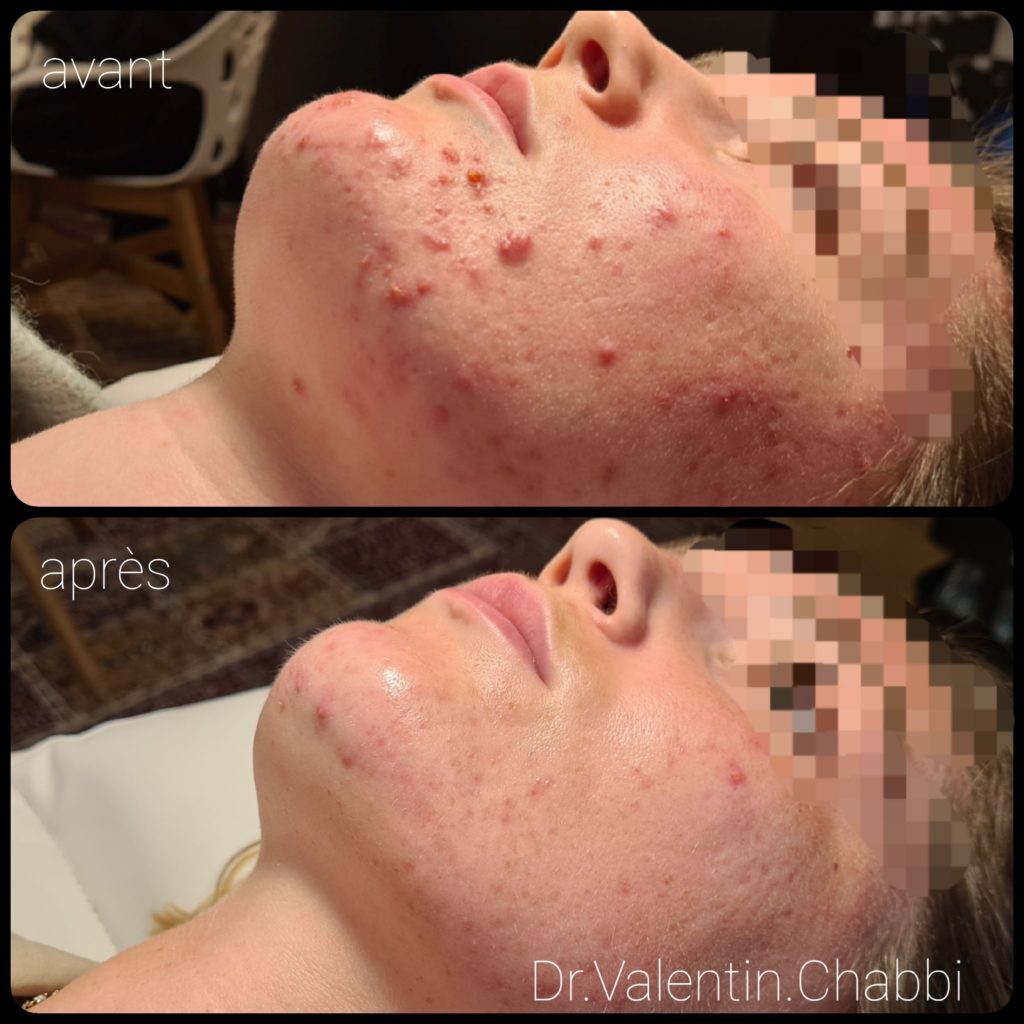 Roaccutane acné pilule