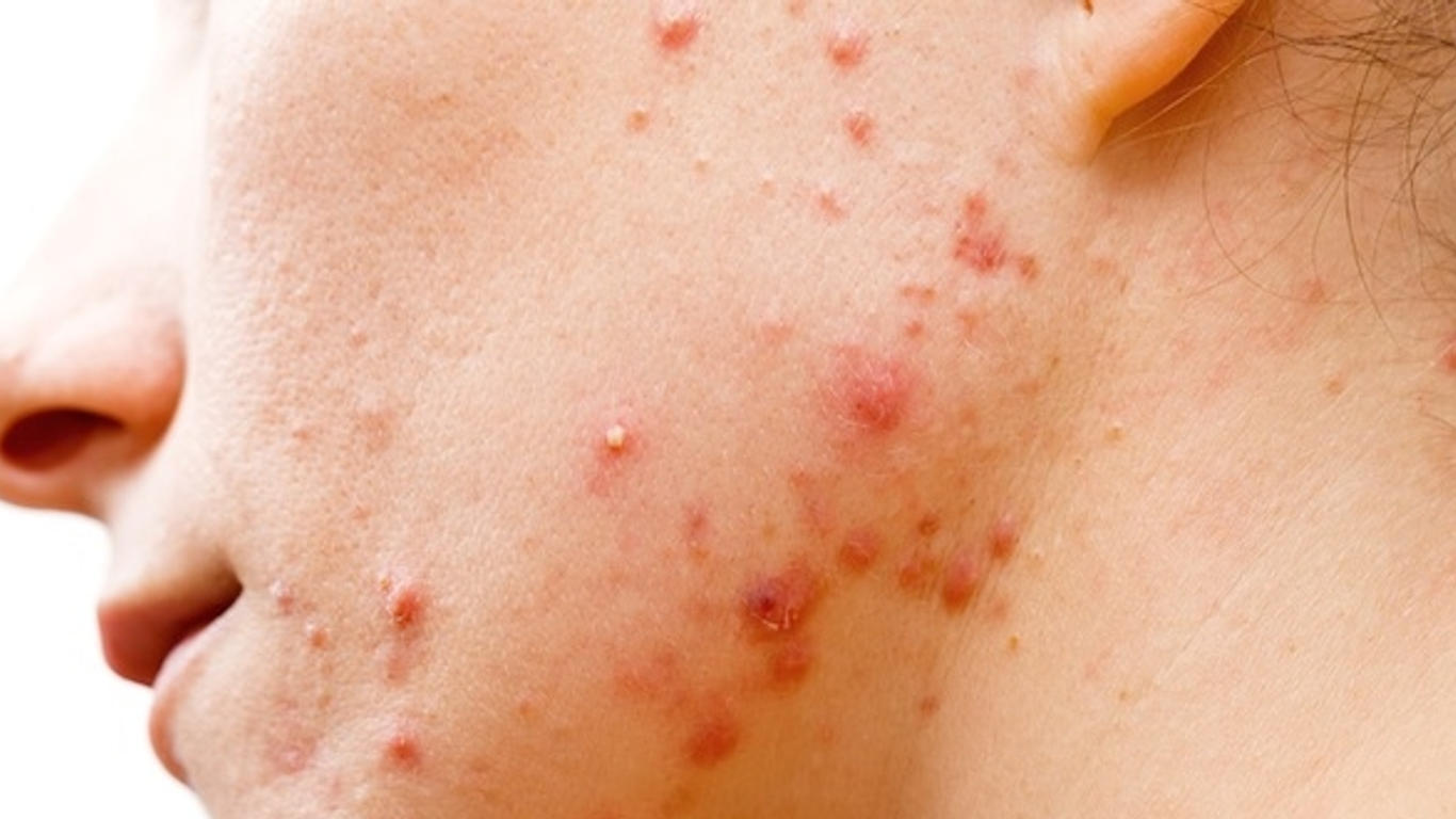 Roaccutane acné pilule