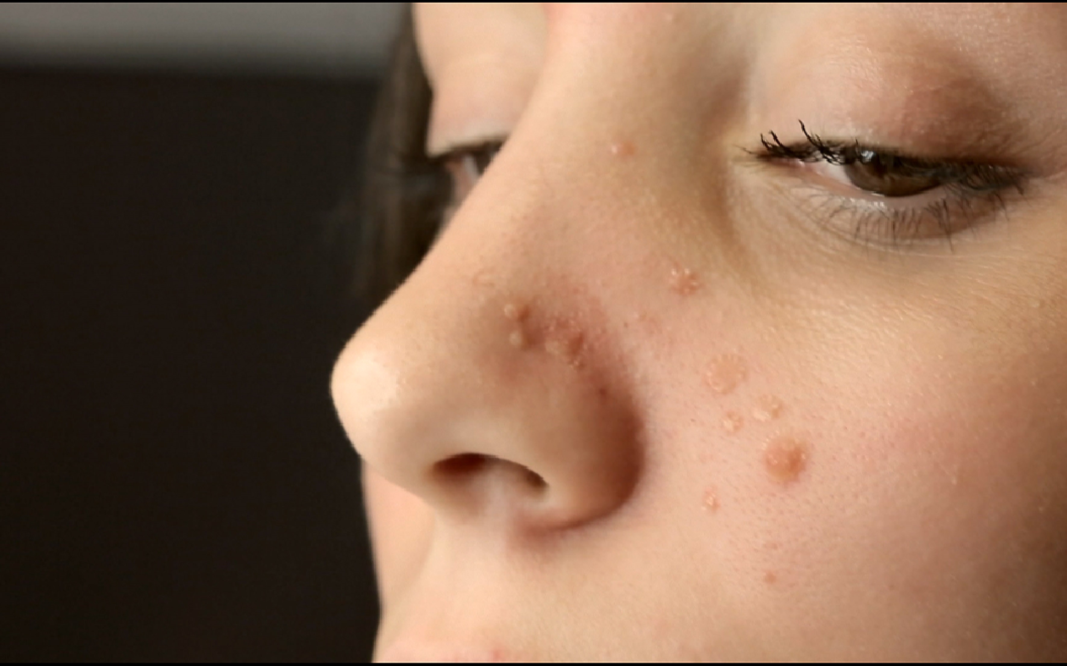 Roaccutane arret pilule