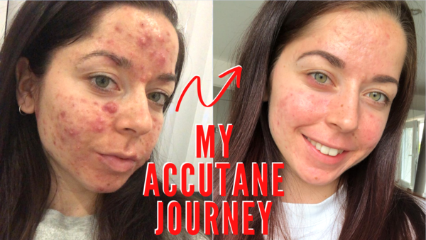 Roaccutane bon marché