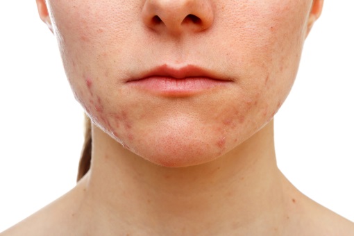 Roaccutane comment acheter