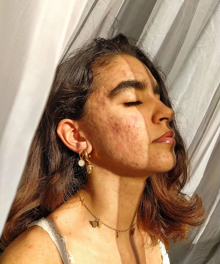 Roaccutane en france
