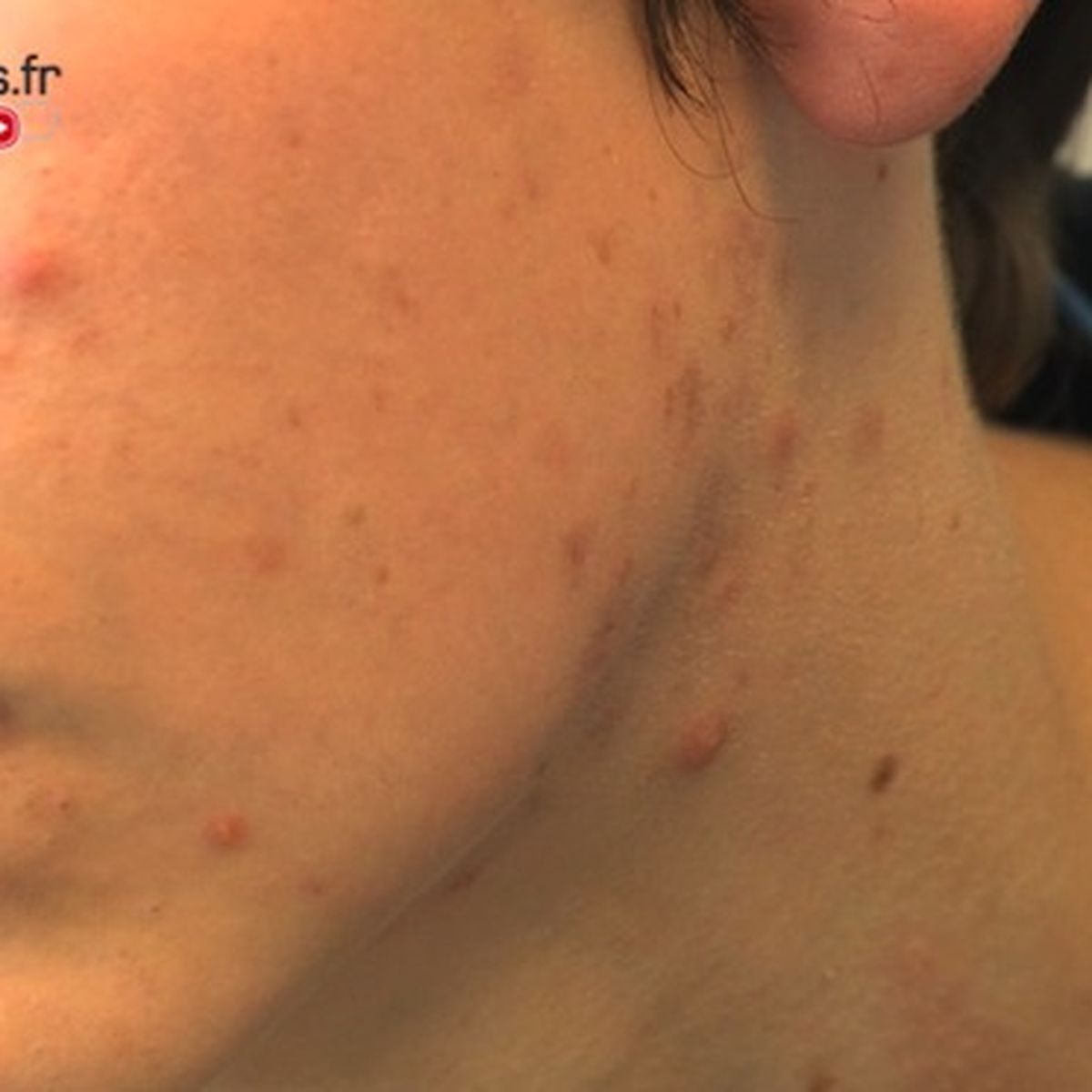 Roaccutane Pilule Obligatoire