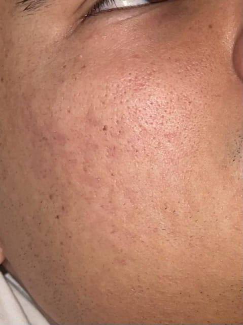 Roaccutane Prix
