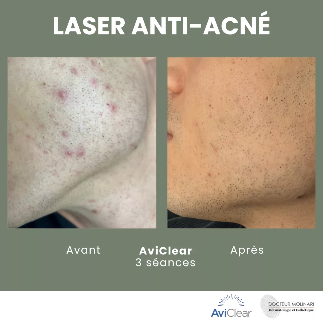Roaccutane prix acné