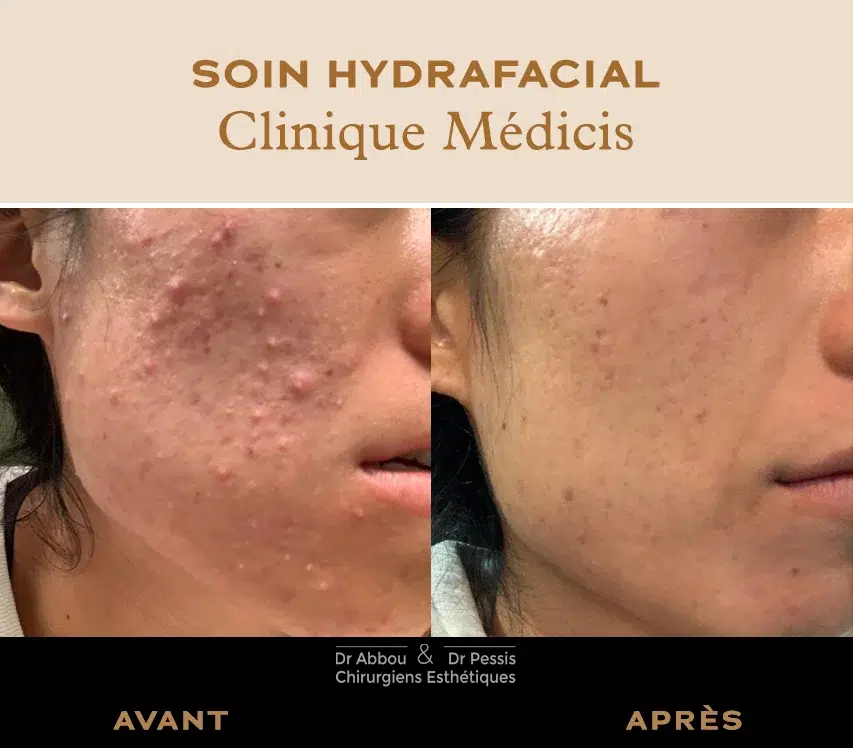 Roaccutane prix france
