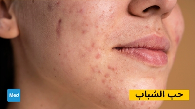 Roaccutane prix pharmacie