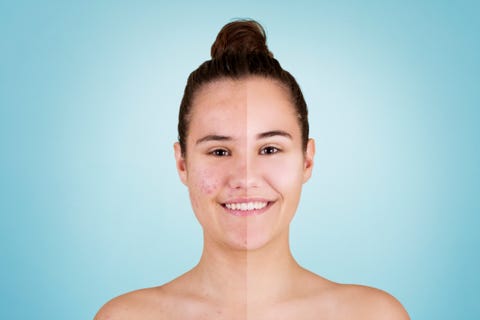roaccutane sans contraception